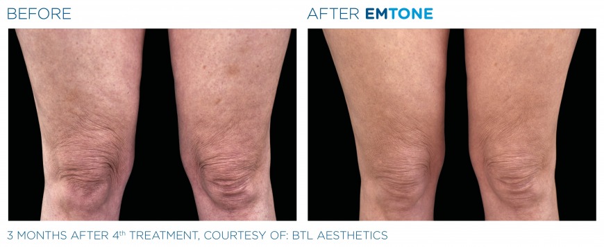 Cellulite treatment in Dubai Cellulite treatment in Dubai